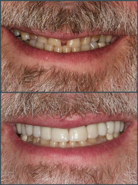 Before & After Images of Cosmetic Dentistry in Beachwood, OH