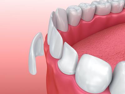 A model of Dental veneers in Beachwood, OH.