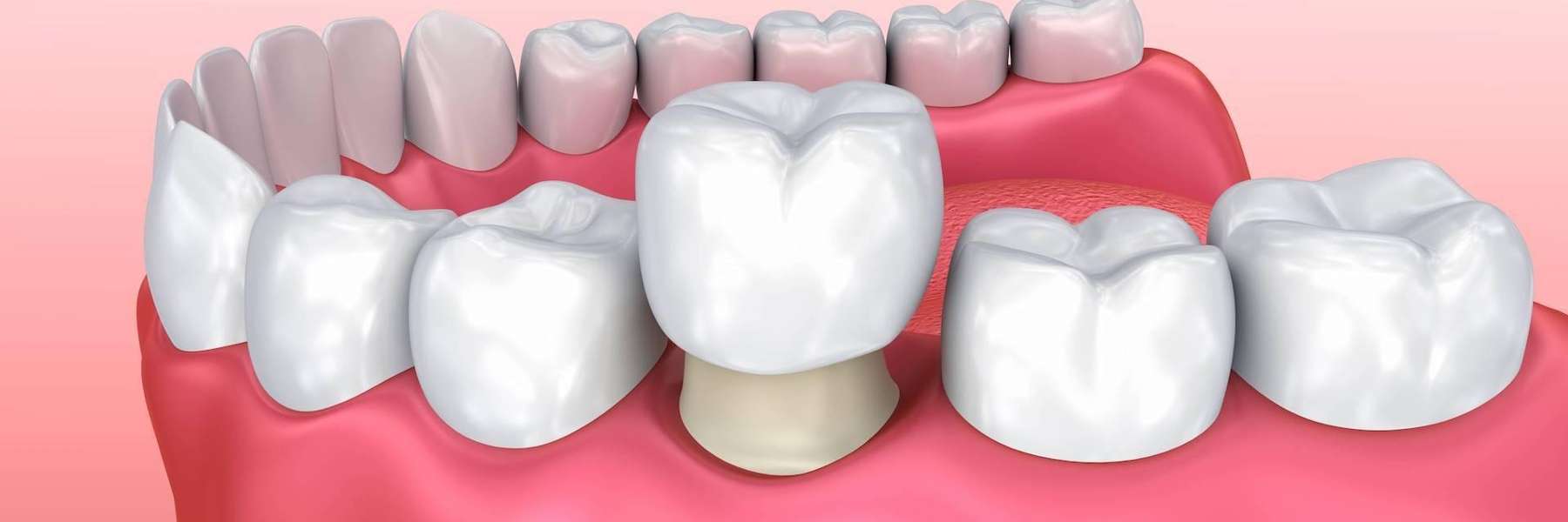 An Illustration of a Dental Crown in Beachwood, Ohio