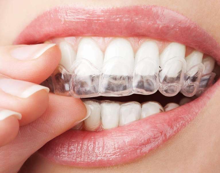 Person placing Invisalign aligner while deciding between Invisalign and clear braces.