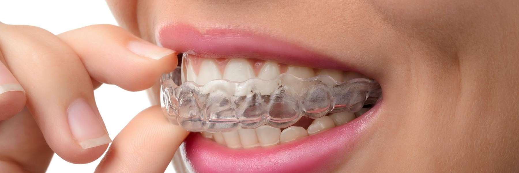 Lady placing Invisalign aligners on her teeth in Beachwood, Ohio