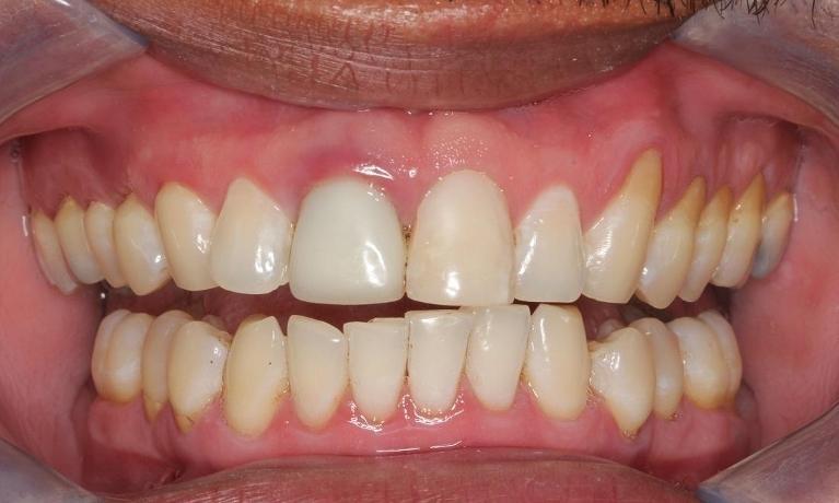 Close up of teeth after pinhole gum regeneration in Beachwood, OH