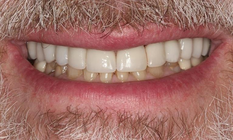 Close up of teeth after dental crowns and implants in Beachwood, OH