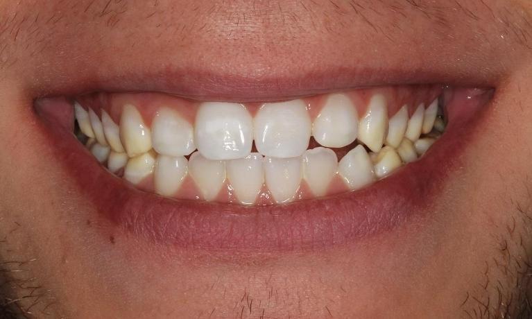 Close up of teeth after professional teeth whitening in Beachwood, OH