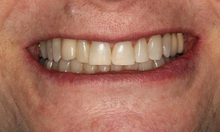 Patients teeth after clear braces, teeth whitening, and dental implants in Beachwood, OH