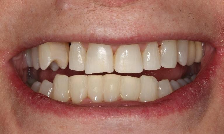 Results from procedure for dental bonding and gum treatment at 44122 dentist office