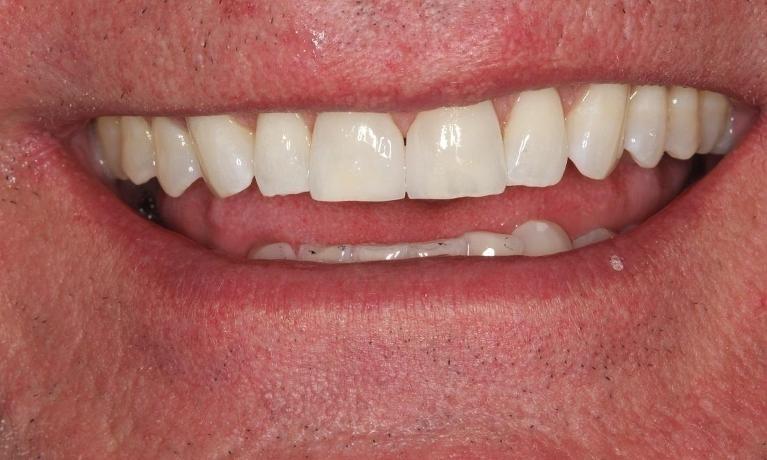 Patients smile showing results from dental bonding by Beachwood OH cosmetic dentist