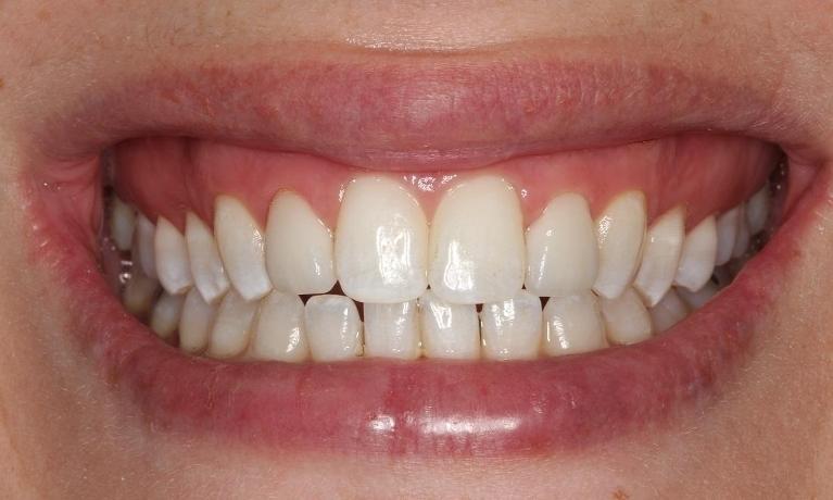 Close up of patients smile after professional teeth whitening & veneers in 44122