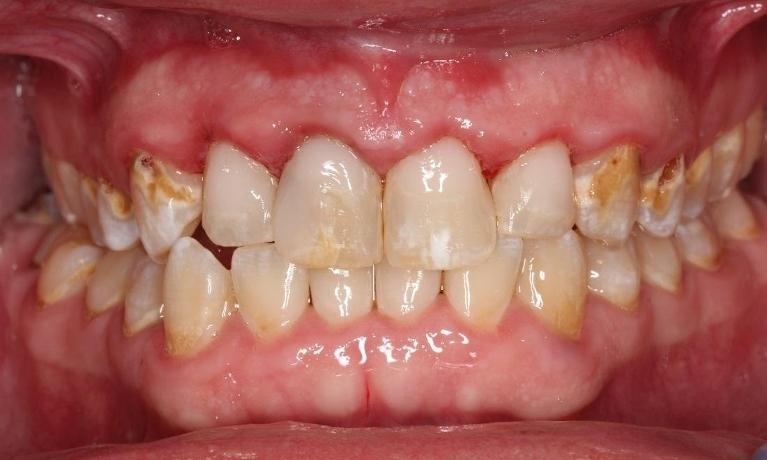 Close up of patient results from periodontal treatment and dental bonding in 44122