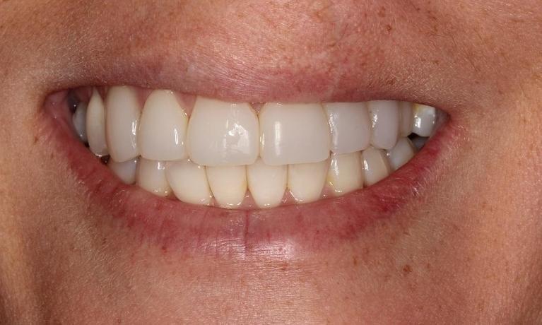 Patient results from freehand resin veneers in Beachwood, OH