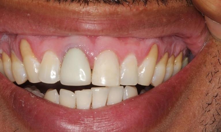 Patients smile before pinhole gum rejuvenation in Beachwood, OH 