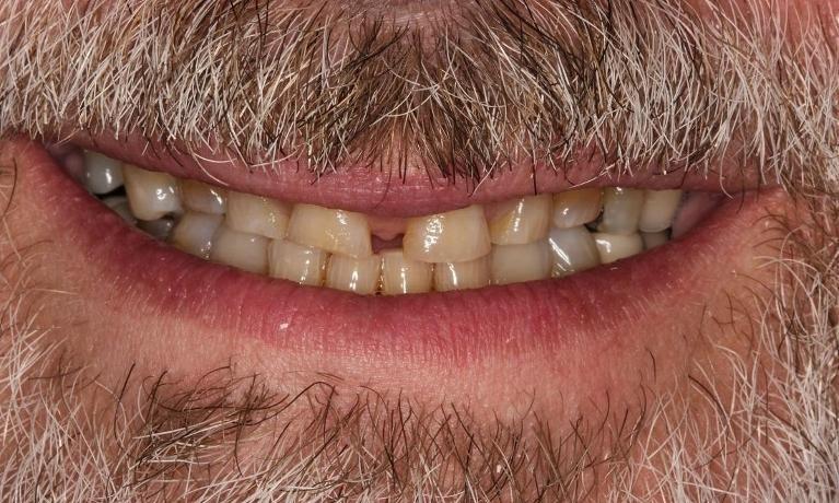Close up of teeth before dental crowns in Beachwood Ohio