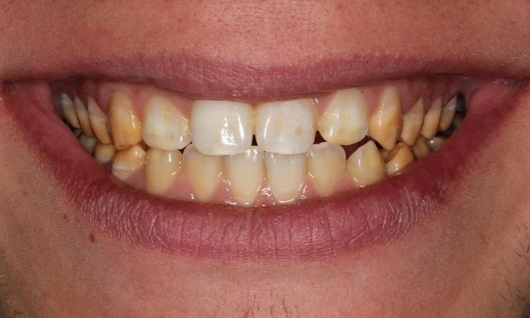 Close up of teeth before KoR Teeth Whitening treatment in Beachwood, OH
