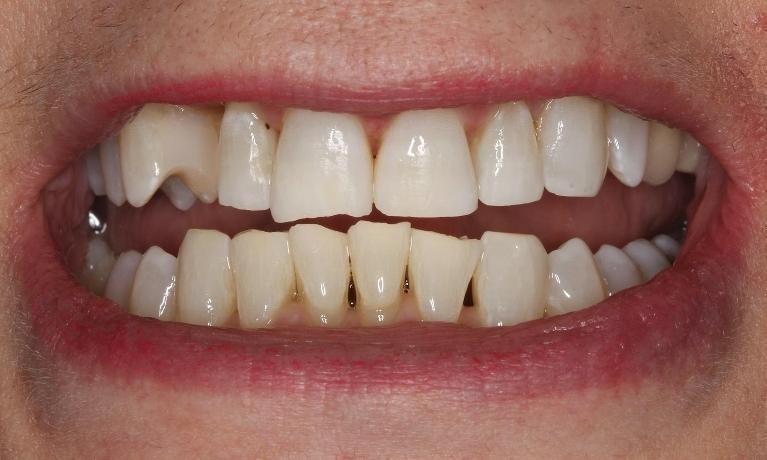 Dental patient showing signs of gum recession at Beachwood dentist office