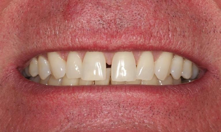Close up of dental patient with gap in front teeth at Beachwood Smiles