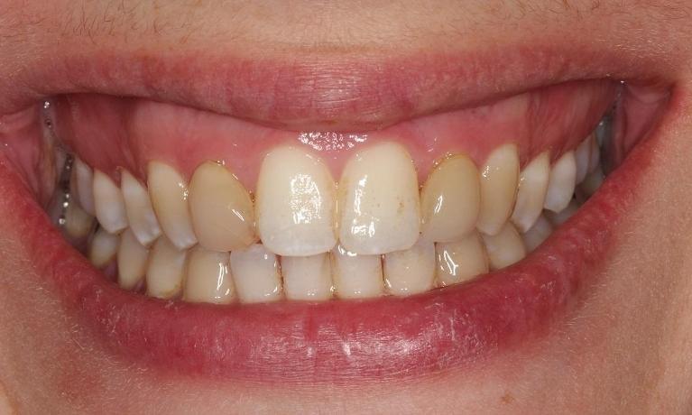 Close up of smile with stained teeth at dentist office near 44120