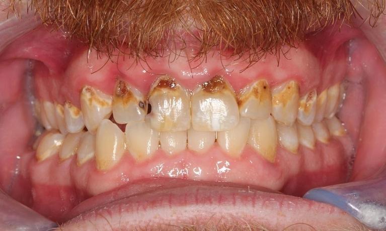 Dental patient at Beachwood Smiles showing signs of gum disease