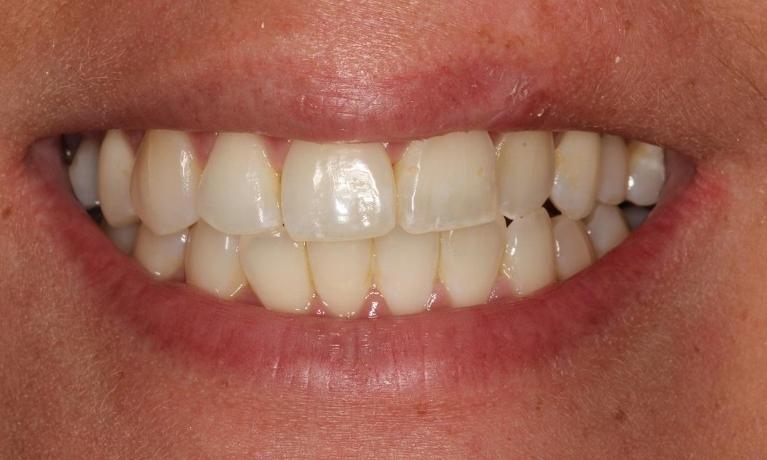 Close up of dental patients smile with misaligned teeth at Beachwood dental office